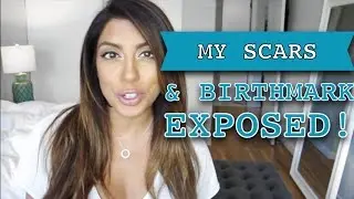 My SCARS and Birthmark EXPOSED! | ALIYA-JASMINE