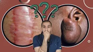 ويش هذا ؟؟ (الجدرة و الندبة المتضخمة)