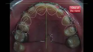 Using the Digital Smile Design in various stages of Orthodontic Treatment.
