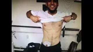 I BOX with a COLOSTOMY Bag-- Michael 