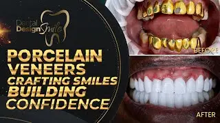 Forget about that outdated gold, and renew your smile with 100% porcelain veneers