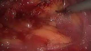 Nefrectom&iacute;a Laparosc&oacute;pica para Donante Vivo en Trasplante - Rev Soc Per Cir Endosc 2019;1(1)