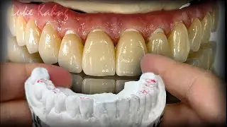 Brilliant Full-Arch Implant Solution for this Patient