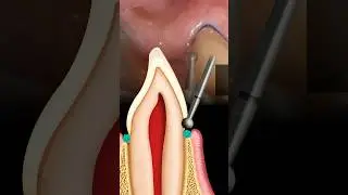 Preparing ANTERIOR Teeth for Zirconia Crowns #dentalshorts