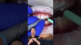Prepless, painless, perfect. 💎 Brianna&rsquo;s smile got a major upgrade with 10 no-shave veneers!