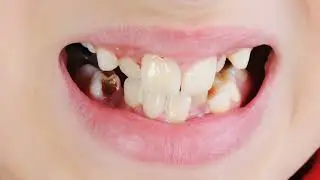 Closing Gaps in Your Smile: Explore Teeth Gap Solutions at iSmile Dental Langley