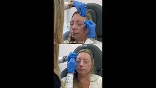 Holiday Botox Offer | Buy 40 Units, Receive 20 Units at No Cost
