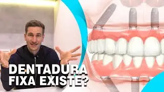 É Possível Parafusar a Dentadura? Oque é Prótese Protocolo? - Heal Odontologia