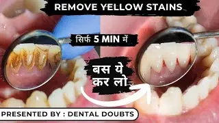 How to whiten teeth at home | Teeth whitening at home | #dentatdoubts #teethwhitening