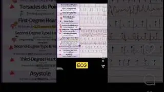 ECG, Normal Sinus Rhythm, Sinus Tachycardia, Sinus Bradycardia, Atrial Fibrillation, Atrial Flutter