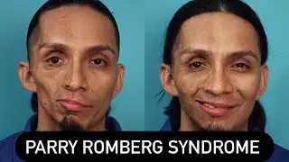 FACIAL HEMIATROPHY-PARRY ROMBERG SYNDROME (ORAL PATHOLOGY)1.5x for better experience