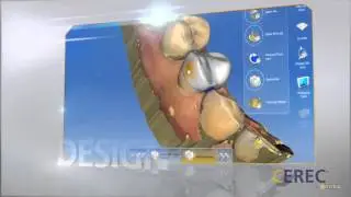 Cerec Restoration