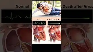 Sudden Cardiac arrest how it's occurs -3D animation #shorts