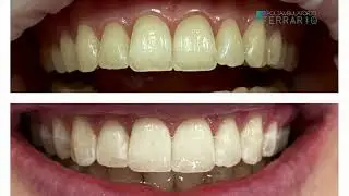 Sbiancamento dentale di ultima generazione