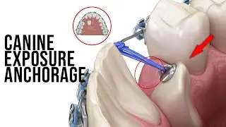 Using TPA and Piggy Back Technique Double Wire for Impacted Canine Exposure Anchorage