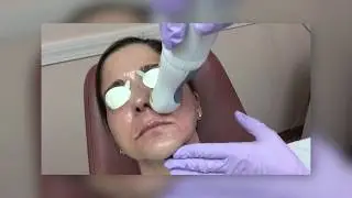 Resurfacing Sun Damaged Skin with Lasers