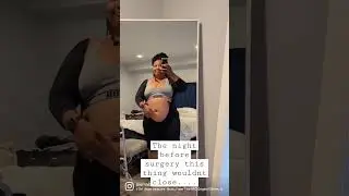 From pre-op to 3 weeks posts-op plus-size mommy makeover