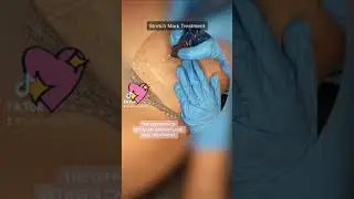 More info on Insta! #shorts #stretchmarkremoval #treatment #stretchmarks