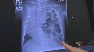 Intermountain Primary Children&rsquo;s Hospital is Leading the Way in Caring for Life-Threatening Fetal Co