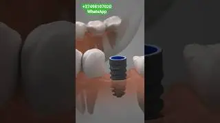 Имплантация в Армении 📩 +37498107020 WhatsApp www.vardandentist.com