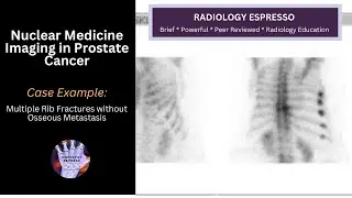 BONE SCAN: Case Example &ndash; Multiple Rib Fractures without Osseous Metastasis (5530)