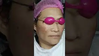 FROM MALANDAY, MARIKINA PICO LASER FOR MELASMA TREATMENT 