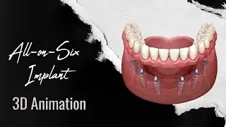 What is All-on-Six and How is it Done? | 3D Animation