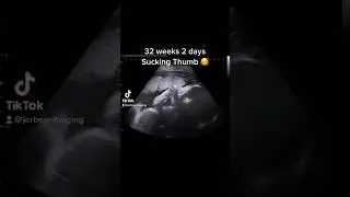 32 weeks 2 days 2D and 3D Ultrasound #jerbearimaging #ultrasound #baby #electiveultrasound