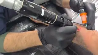 Remoção de Tatuagem Verde e multiplas cores com Laser PicoSure aqui na Hell Tattoo