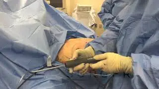 Gynecomastia Treatment (Procedure video from the OR)