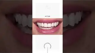 Another breathtaking smile makeover in Beverly Hills #shorts #dentistry #smilemakeover
