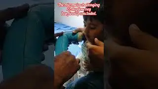 Excited,😲..21-day finally concluded/how to remove synthetic bandage /kids bandage reopening #youtube