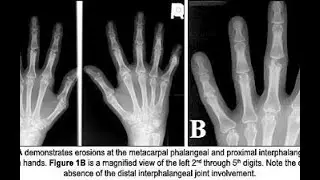 Meaning of Bone involvement And Joint involvement; medical contexts of musculoskeletal system