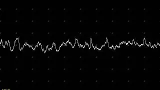 EMG teaching video 14: Endplate noise and spikes