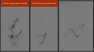 Prostatic artery embolization (PAE) for control of hematuria in a case of prostatic carcinoma