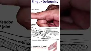 mallet finger deformity#the_physio_doctor#anatomy#physiotharapist#humananatomy#motivation#biology