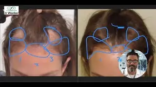 Severe Shedding at 28: Genetic Hair Loss & Alopecia Areata Solved | Dr Ray Nettles BRC Revie