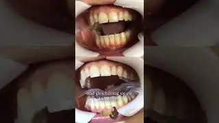 🦷 Nat&uuml;rlich wei&szlig;ere Z&auml;hne &ndash; ohne Chemie & mit Tiefenwirkung?