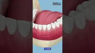 Why is it important to avoid smoking after getting a dental implant?