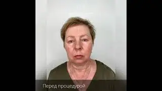 Exomage RED Double Layer Kit - двойная маска с ионофорезом на основе экзосом в действии!