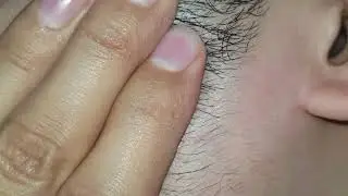 Relaxing Asmr Ingrown hair satisfying | Massage therapy videos | Blackheads removal Hair