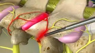 What is Cervical Facet Radiofrequency Neurotomy?