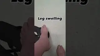 #dvt #deepveinthrombosis #podiatry #legpain #legswelling