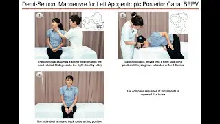 Demi-Semont Manoeuvre for Left Apogeotropic Posterior Canal BPPV