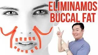 [Ejercicio] ¡Meta lucir -13 años! Quitar grasa de los cachetes “buccal fat”