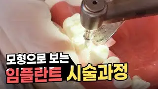 임플란트 수술 과정 실제로 촬영해보았습니다.