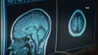 Correction: Study of Lewiston shooter's brain showed traumatic injury