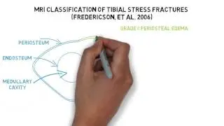 Stress Fracture MRI classification