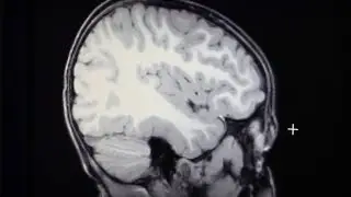 Большой мозг и белое вещество: два исследования раскрывают подсказки о подтипах аутизма
