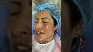 BENEFICIOS PEELING DRABETH  #medicinaestetica #drabeth #viveelcambio
